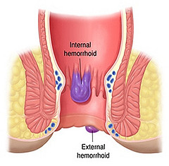 Internal and external view of hemorrhoids from a poster